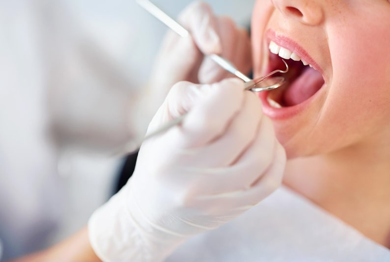 Por qué se despegan las carillas dentales