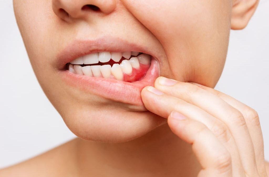 ¿Cómo quitar las manchas de tabaco en los dientes?
