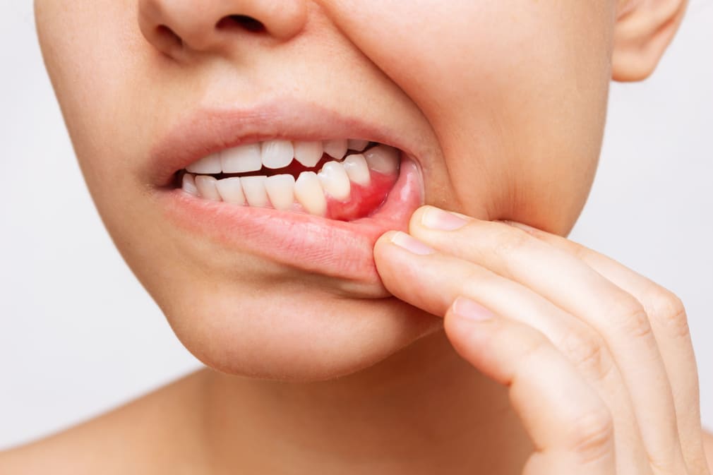 Causas del Sangrado de Encías: Una Señal de Alerta para tu Salud Dental y Tu Sonrisa Perfecta