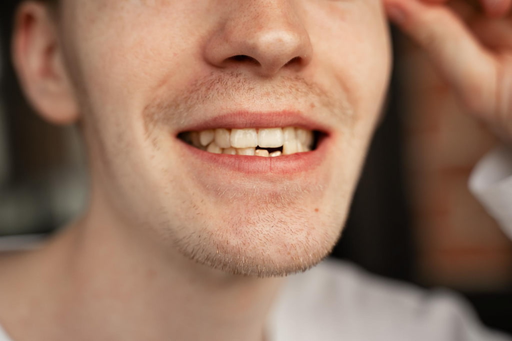 tratamientos dientes desgastados