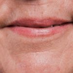 Wrinkles Around the Mouth: How to Remove Them and Flaunt a Youthful Smile