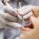 ¿Qué es una endodoncia?