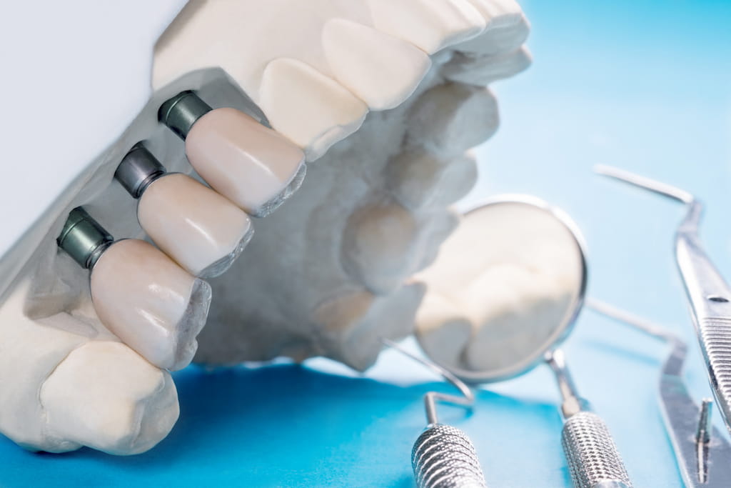Implantes dentales de carga inmediata