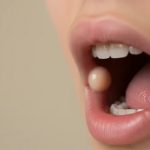 ¿Qué es un fibroma oral? Causas, síntomas y tratamiento
